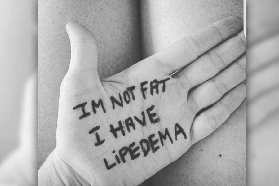 im not fat, i have lipedema
