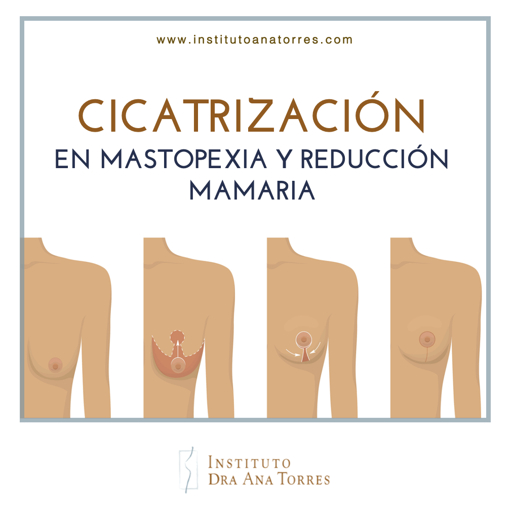cicatrización mastopexia y reducción de pecho en barcelona