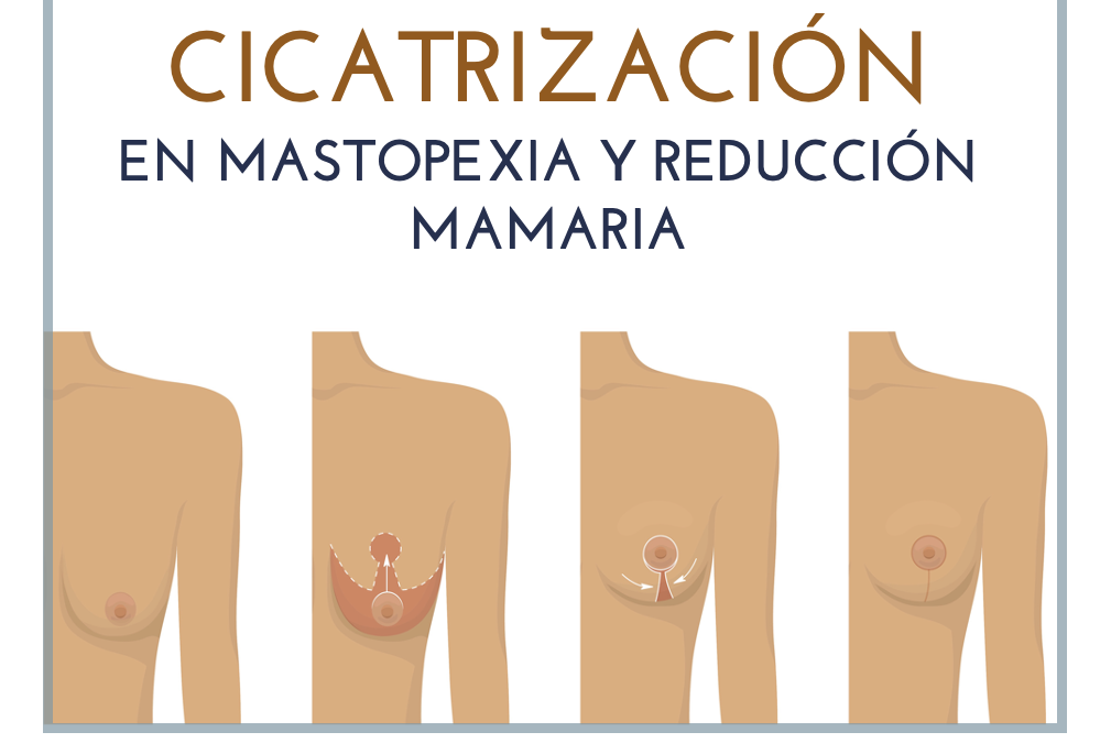 Cómo reducir las cicatrices en la mastopexia y reducción de pecho