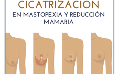Cómo reducir las cicatrices en la mastopexia y reducción de pecho