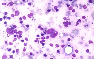 Linfoma ALCL