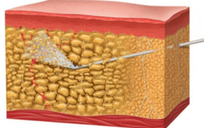 Water assisted liposuction (wal) en el tratamiento del lipedema
