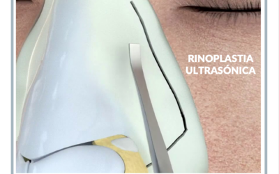 Rinoplastia ultrasónica en Barcelona