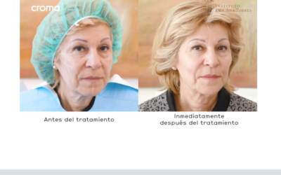 Tratamientos para la flacidez de cara y Cuello: Los hilos tensores