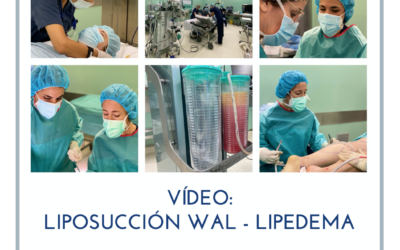 Tratamiento quirúrgico del Lipedema con Liposucción WAL en Barcelona