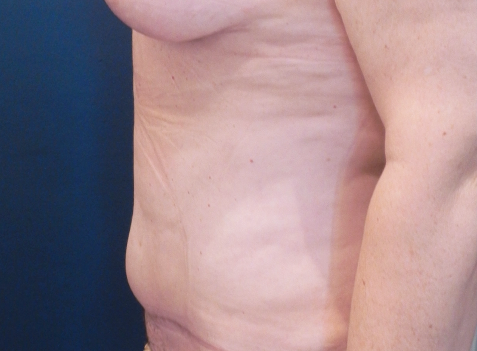 2.procedimiento-abdominoplastia-barcelona